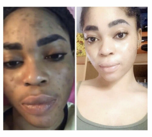 CLIN-CAP GEL ACNE & PIMPLES RoyalGlow Organics